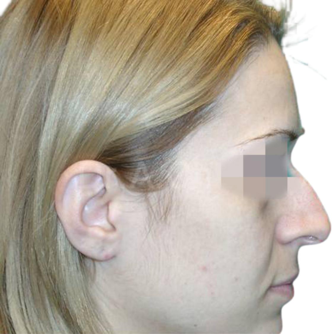 Before-Rhinoplasty